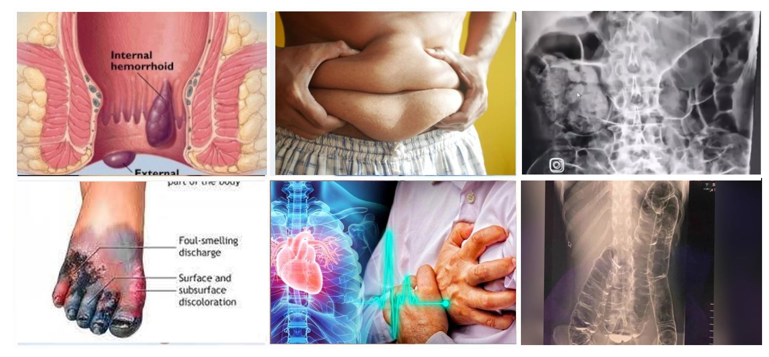 Cegah Wasir, Obesitas, Diabetes, dan Resiko Penyakit Jantung Dengan Seraya Nutrisi Kaya Serat Pangan